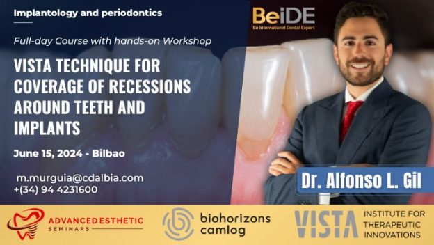 VISTA Technique for Coverage of Recessions around Teeth and Implants - Featured image