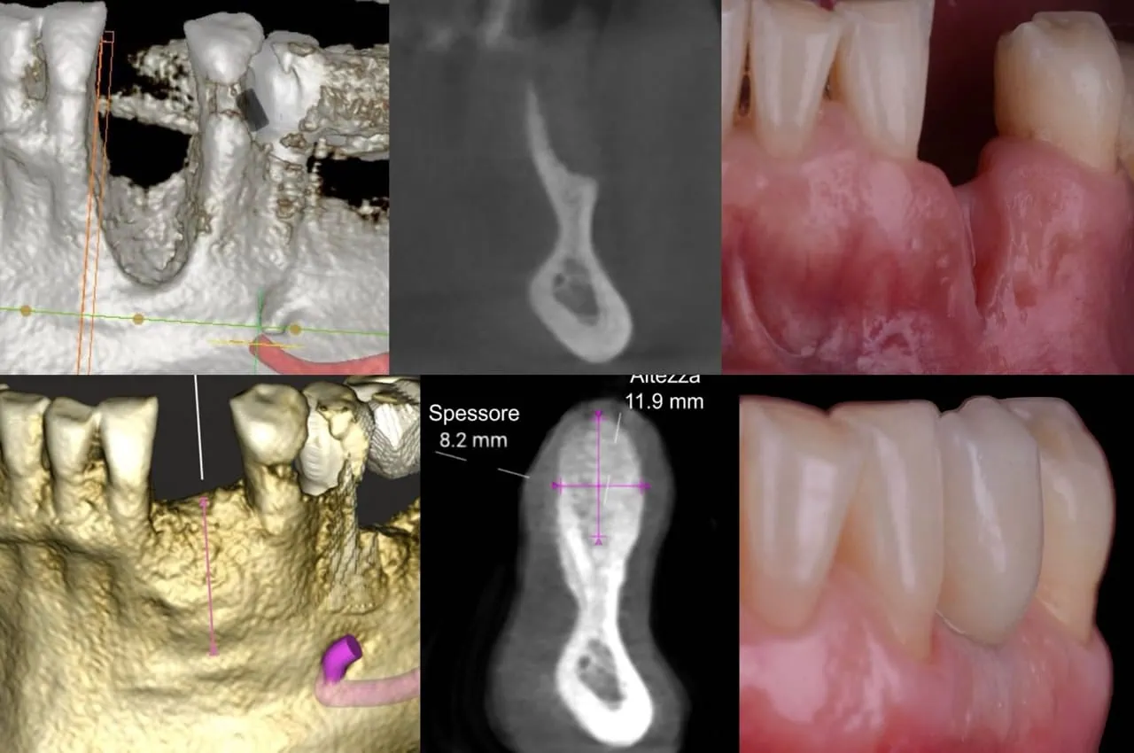 Dr. Roberto Rossi GBR - Clinical case 01