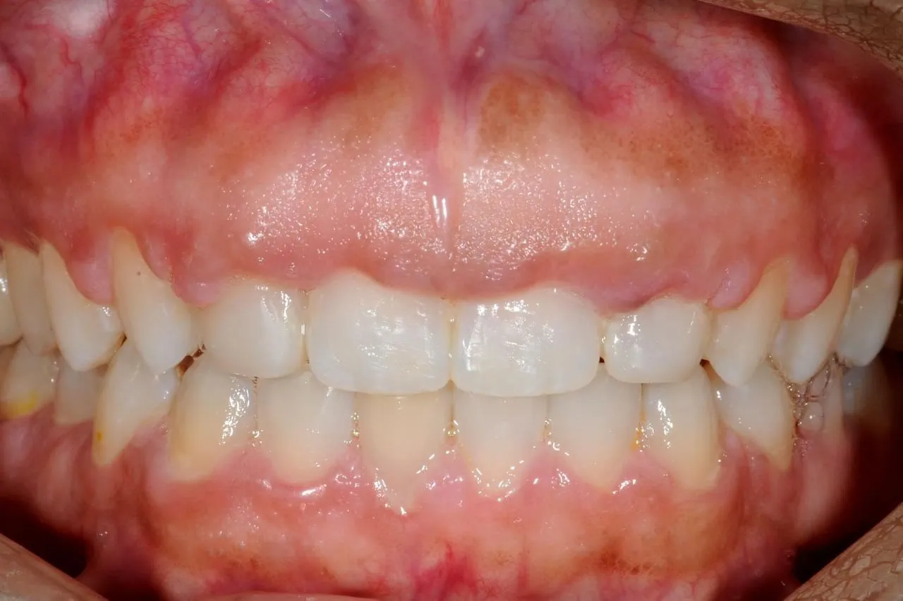 Dr. Roberto Rossi GBR - Clinical case 04-A