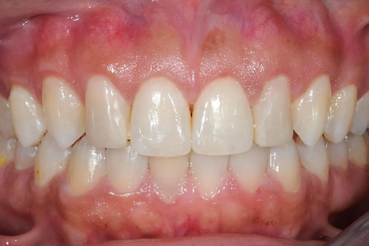 Dr. Roberto Rossi GBR - Clinical case 04-B