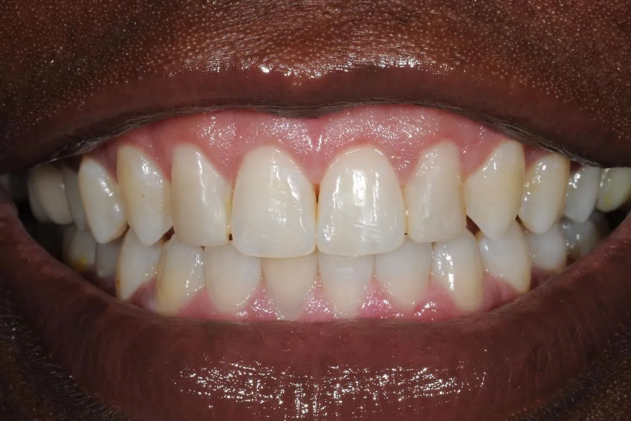 Dr. Roberto Rossi GBR - Clinical case 04-C