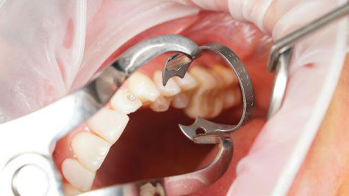 Microscopically Guided Rubber Dam Integration - Featured image