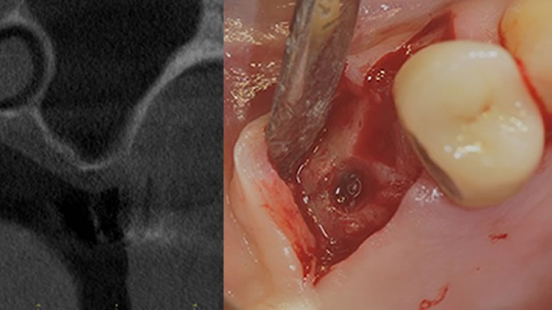 Claudio Stacchi - Clinical Case 1 - Featured image
