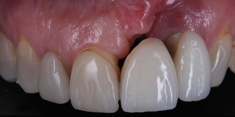 Curso de Cirugía Mucogingival - Imagen ilustrativa 01