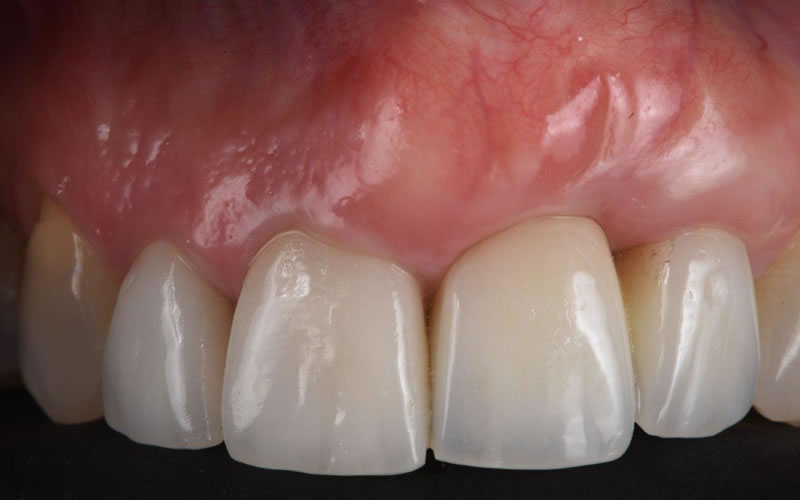 Curso de Cirugía Mucogingival - Imagen ilustrativa 02